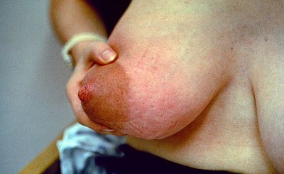 Mastitis_Peau_d'orange_MarmetCh